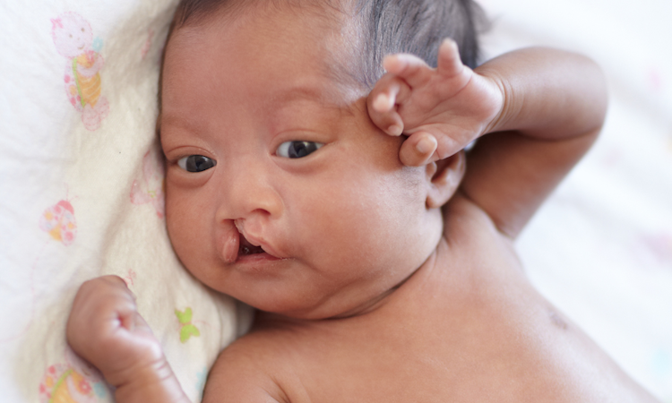 What is Cleft Lip and Cleft Palate?
