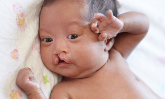 What is Cleft Lip and Cleft Palate?
